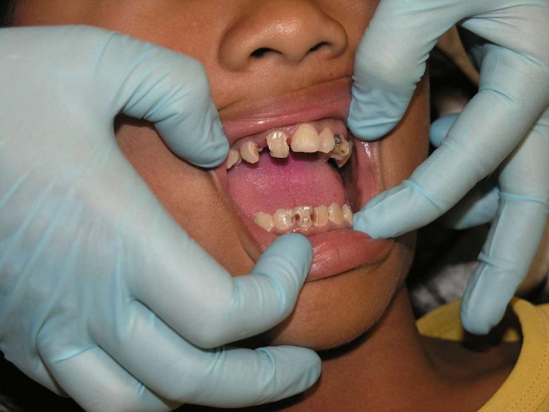 拔牙几天后可以带牙套拔牙后如何护理